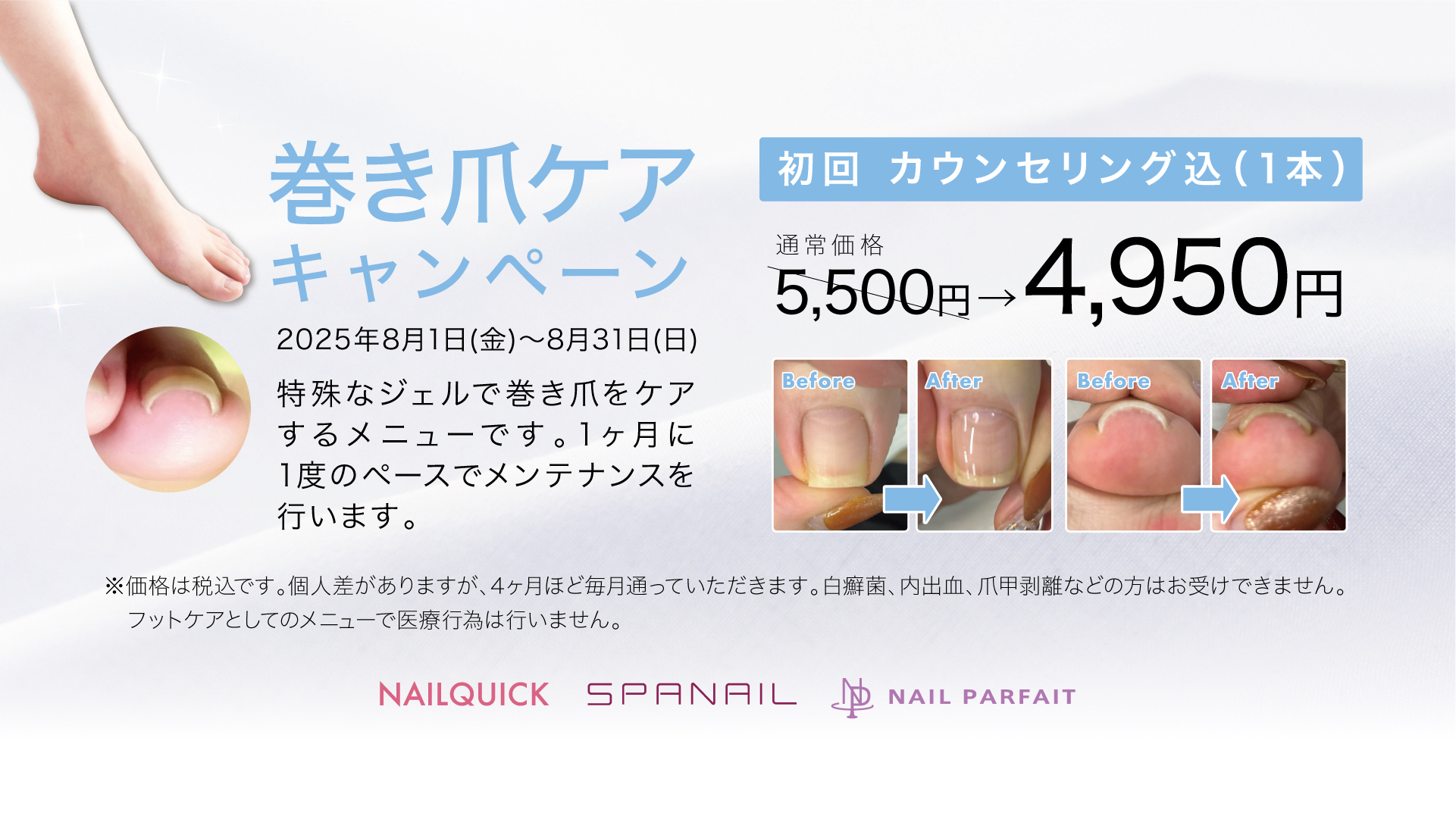 巻き爪ケア